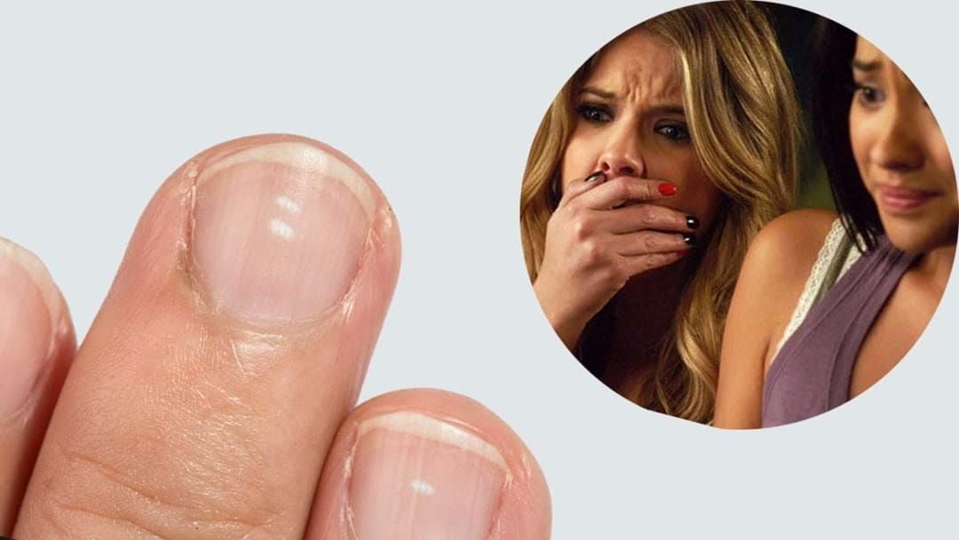 The Mysterious White Spots On Your Nails Do NOT Mean What You Think | Hit  Network