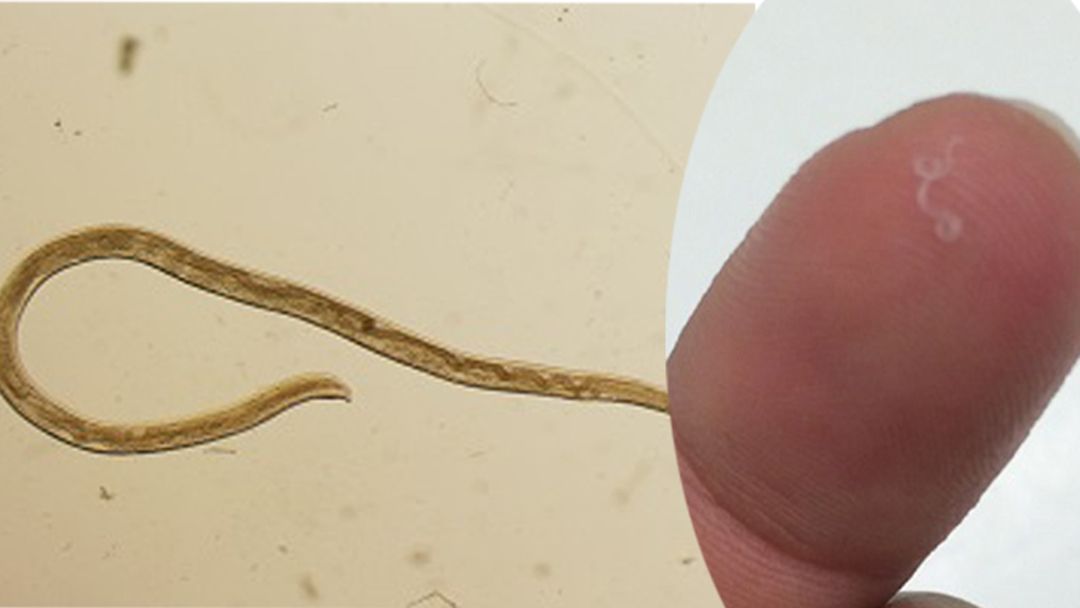 Article heading image for Doctors Pull 14 "Alive And Squiggling" Worms From Woman's Eye