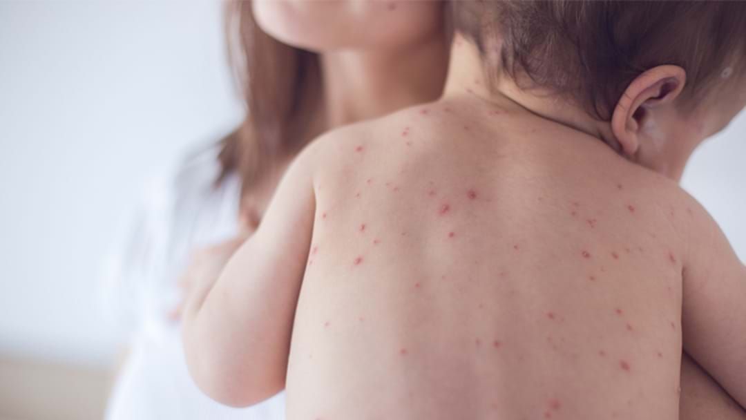 Article heading image for Warnings After Measles Outbreak In Melbourne Suburbs 