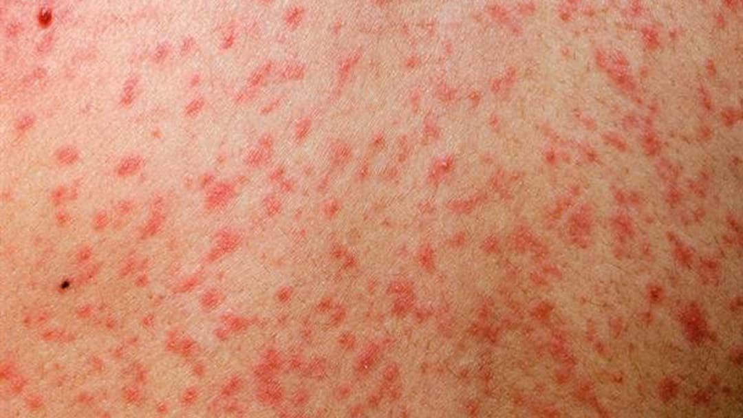 Article heading image for Second Measles Case Confirmed In Cairns.