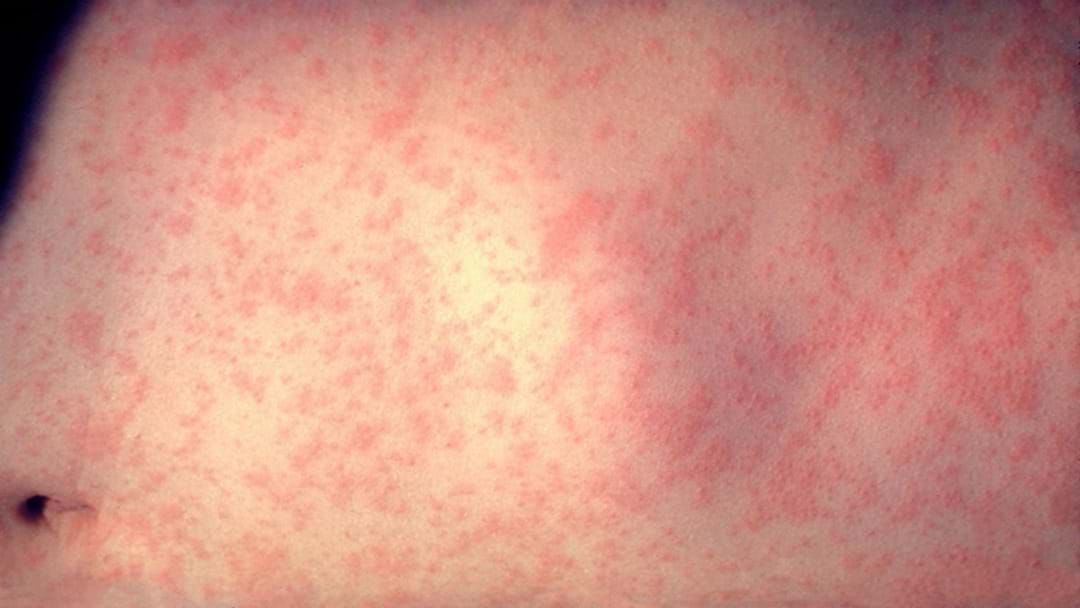 Article heading image for MEASLES ALERT: Two Confirmed Cases In The Hunter