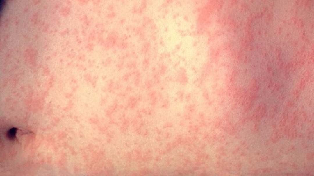 Article heading image for Measles Alert Issued On Brisbane's North Side