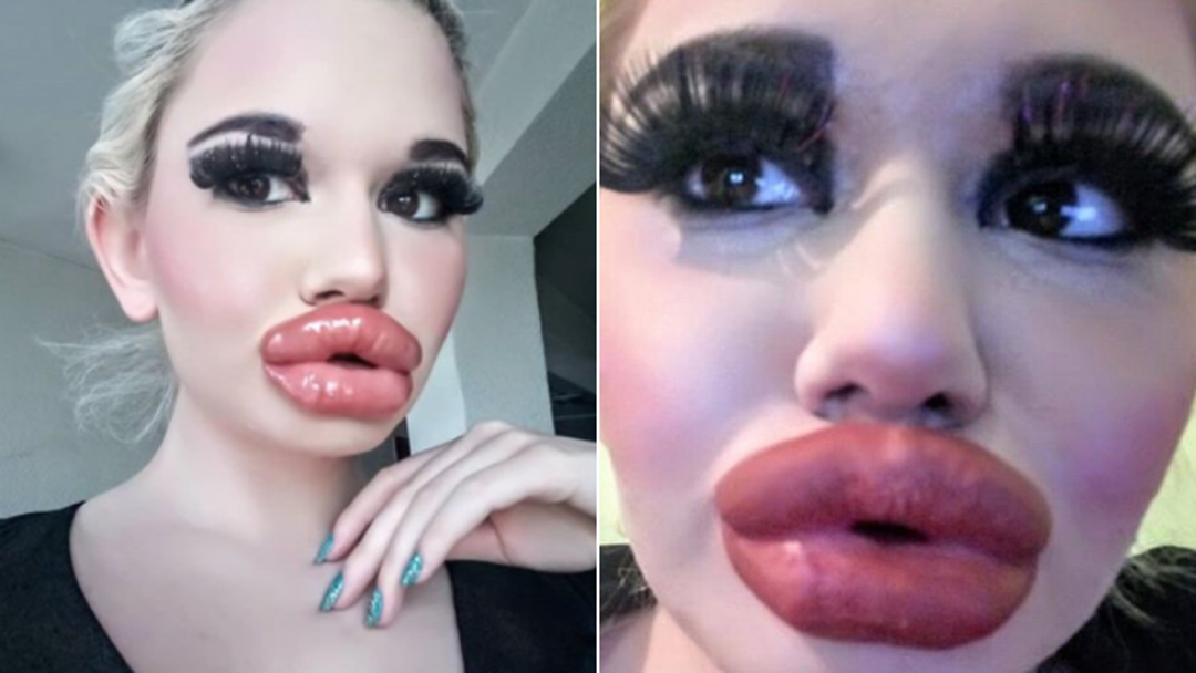 Article heading image for 22-Year-Old Bulgarian Woman Says She "Didn't Count The Money" To Get Biggest Lips In The World