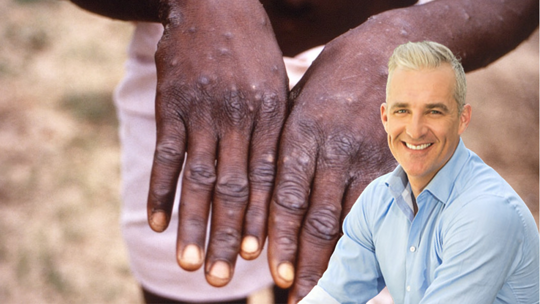 Article heading image for Should We Be Worried About Monkeypox? Dr Andrew Rochford Explains 