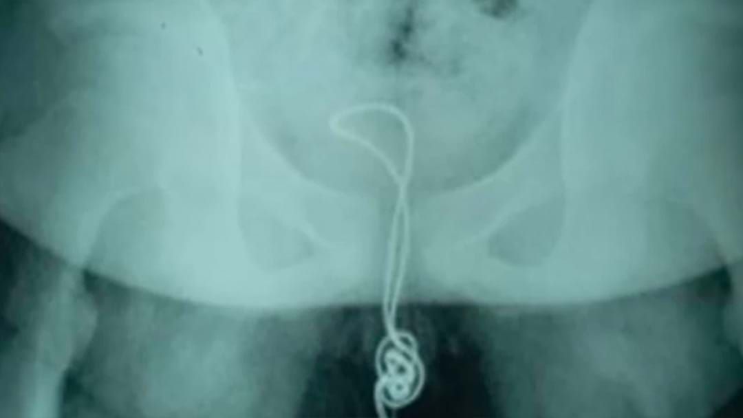 Article heading image for Teen Undergoes Surgery After Getting USB Cable Stuck In Penis