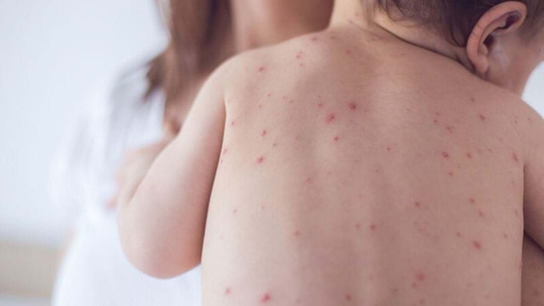 Article heading image for Attention Busselton Locals: The Measles Are Back