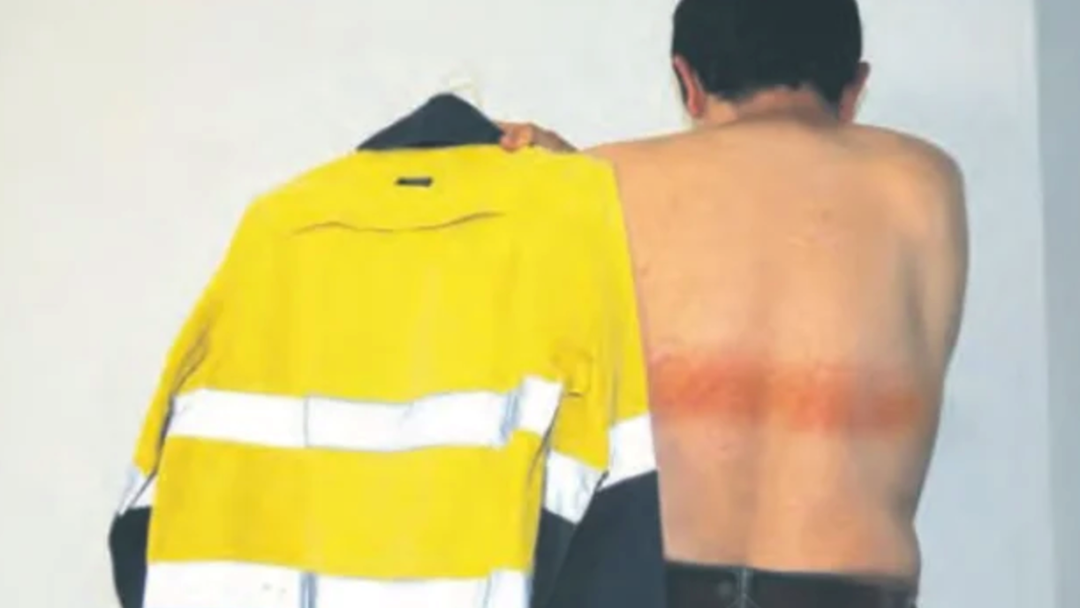 Article heading image for Warning After Man Gets Serious Burns From High-Vis Jacket