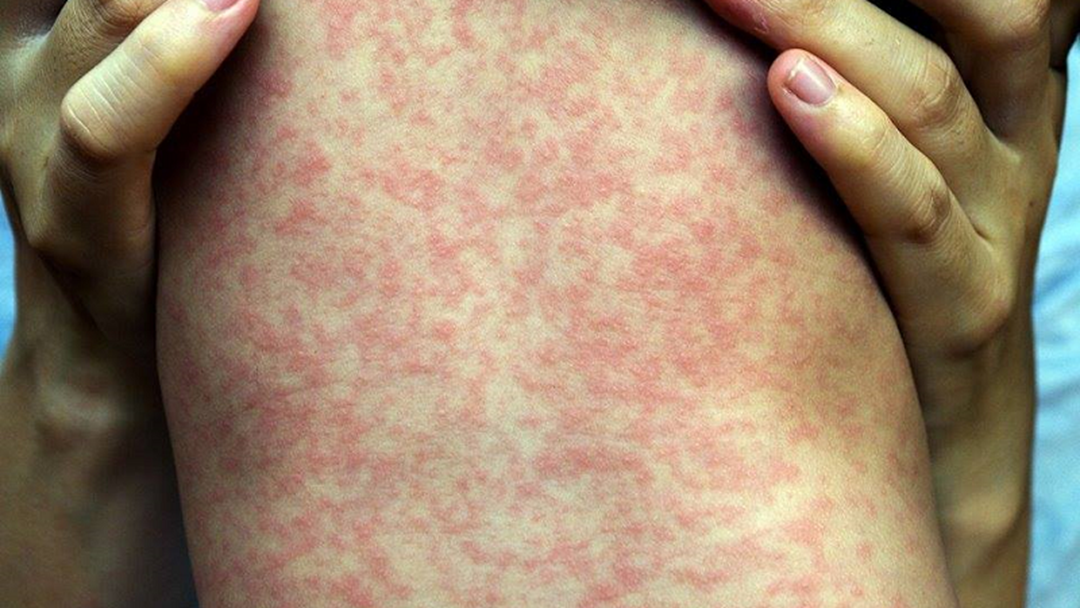 Article heading image for There's A Measles Alert For Perth & Albany